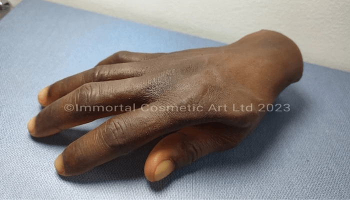 Nigerian firm develops bionic arms for amputees