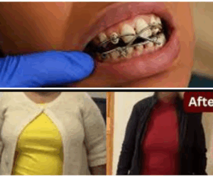 Jaw Wiring for Weight Loss: Risks, and Expert Advice