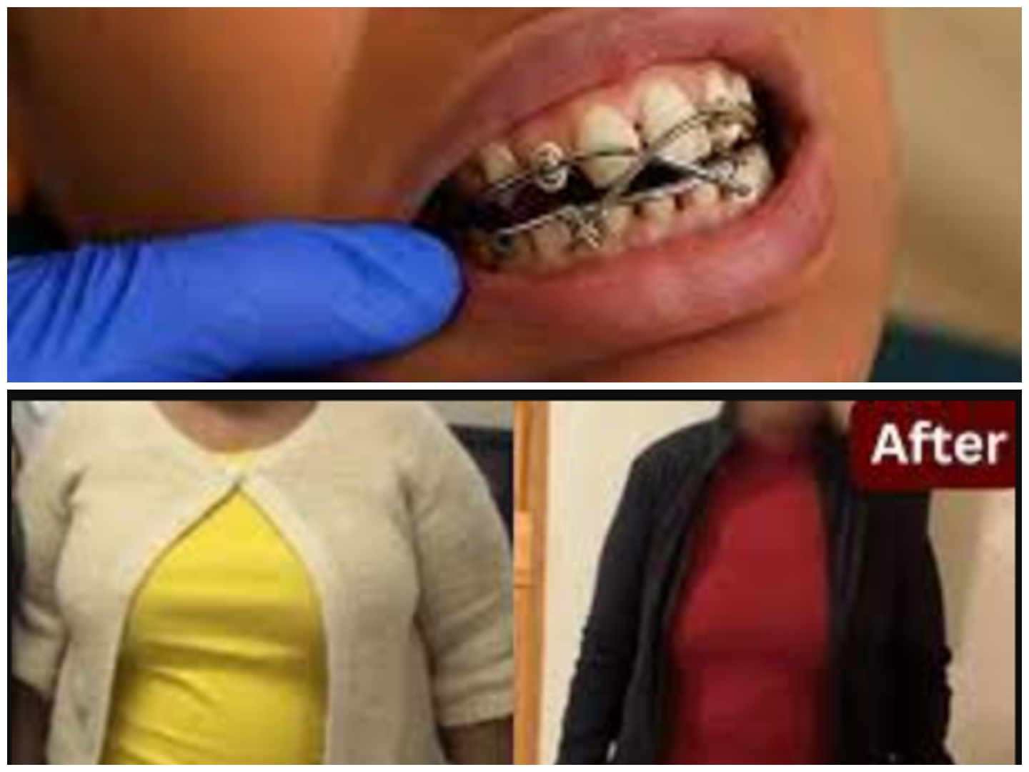 Jaw Wiring for Weight Loss: Risks, and Expert Advice