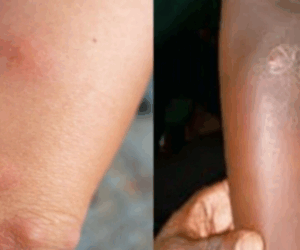 Silent but dangerous – what you need to know about Buruli Ulcer killing Adamawa residents