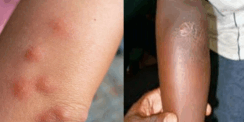 Silent but dangerous – what you need to know about Buruli Ulcer killing Adamawa residents