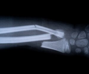 Chinese scientists develop ‘bone glue’ that heals fractures in minutes
