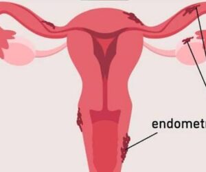 What to know about Endometriosis, pain beyond menstruation