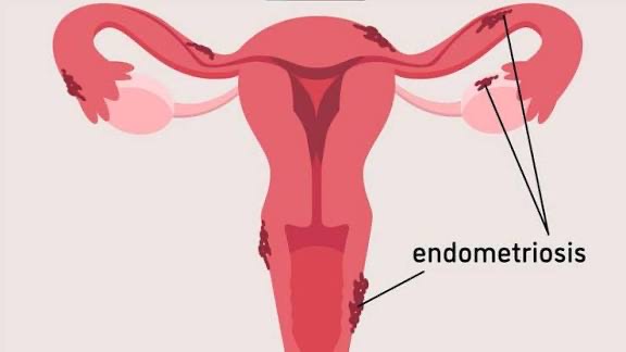 What to know about Endometriosis, pain beyond menstruation