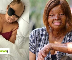 ‘I Couldn’t Blink Properly’ – Sosoliso Plane Crash Survivor, Kechi Okwuchi, Undergoes Eyelid Surgery