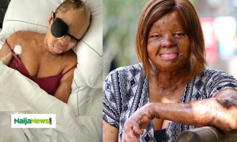 ‘I Couldn’t Blink Properly’ – Sosoliso Plane Crash Survivor, Kechi Okwuchi, Undergoes Eyelid Surgery