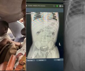 Woman shares how her daughter swallowed a nail but fortunately excreted it without surgery (WATCH)