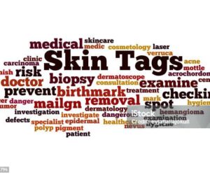 Are Your Skin Tags Trying to Tell You Something? – Daily Trust