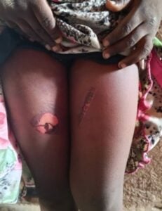 Another Bauchi housewife allegedly burns 5-year-old stepdaughter for bedwetting