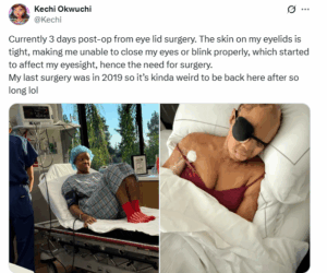 Sosoliso plane crash survivor Kechi Okwuchi undergoes eyelid surgery