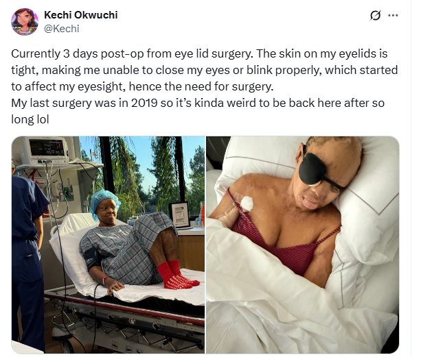 Sosoliso plane crash survivor Kechi Okwuchi undergoes eyelid surgery