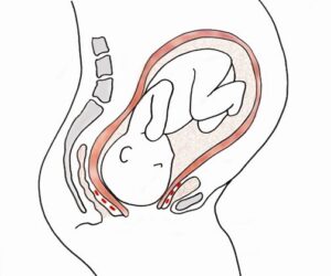 FG Frees 1,600 Women From Obstetric Fistula Burden, Says NHIA