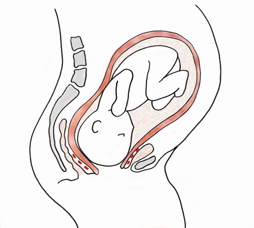 FG Frees 1,600 Women From Obstetric Fistula Burden, Says NHIA