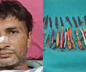 Doctors remove 29 spoons, 19 toothbrushes, and pens from a Drug addict’s stomach