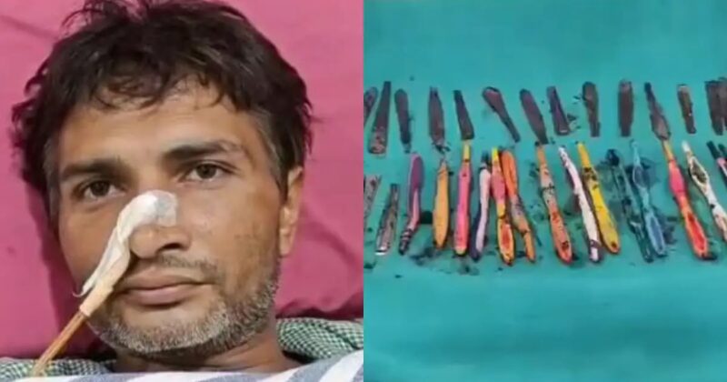 Doctors remove 29 spoons, 19 toothbrushes, and pens from a Drug addict’s stomach