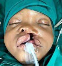 250 Cleft Patients Treated By Smile Train, UITH In Kwara