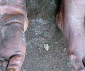 Delta govt offers free surgeries for hydrocele, lymphatic filariasis patients