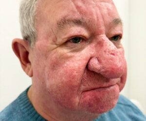 My nose has swelled so much, I worried about frightening children. I couldn’t kiss my wife too