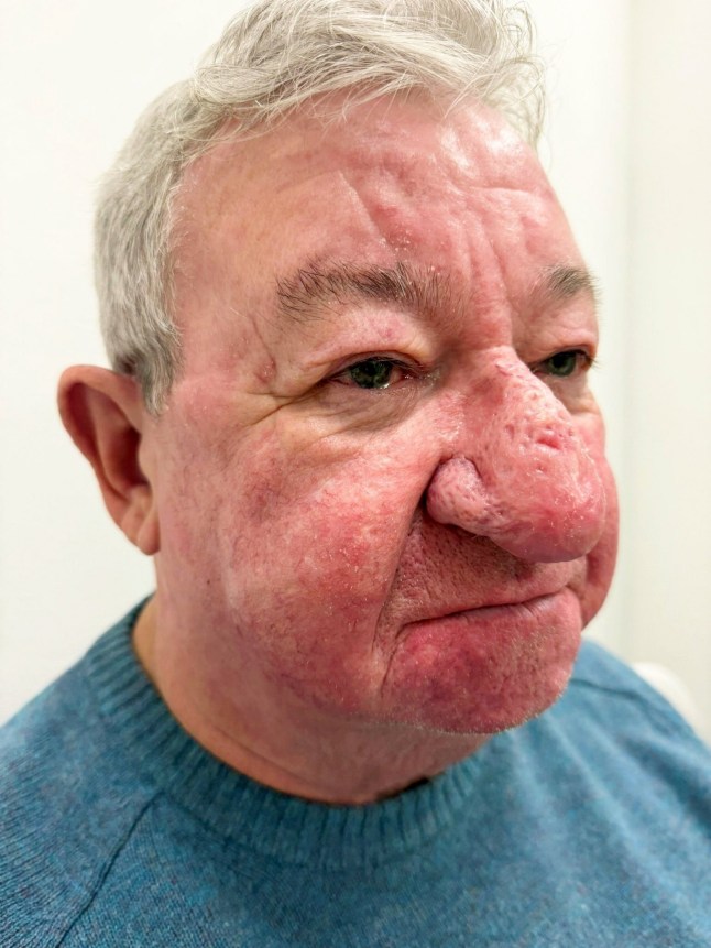 My nose has swelled so much, I worried about frightening children. I couldn’t kiss my wife too