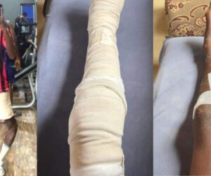 Baddy of Lagos finally removes leg cast, shares post-surgery recovery progress