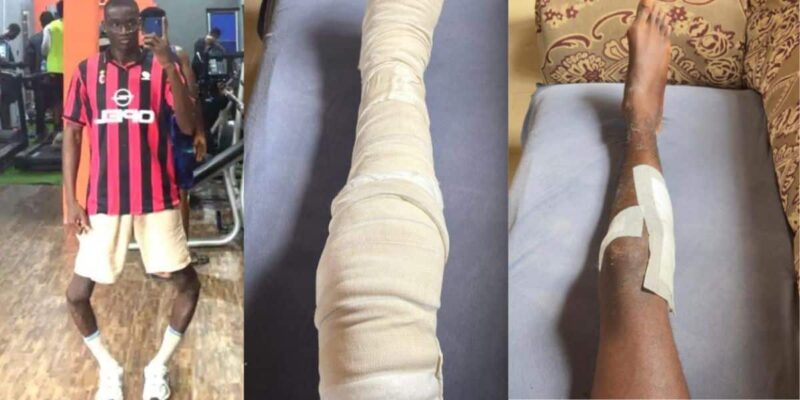 Baddy of Lagos finally removes leg cast, shares post-surgery recovery progress