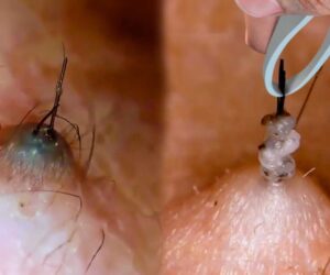 How to Get Rid of Ingrown Hair: Simple, Safe, and Effective Tips That Work