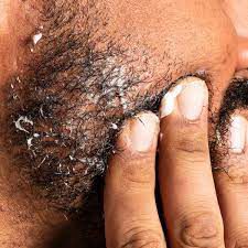 What Causes Beard Dandruff and How to Get Rid of It for Good
