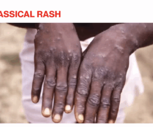 Adewole Urges Urgent National Effort To Tackle Mpox Disease