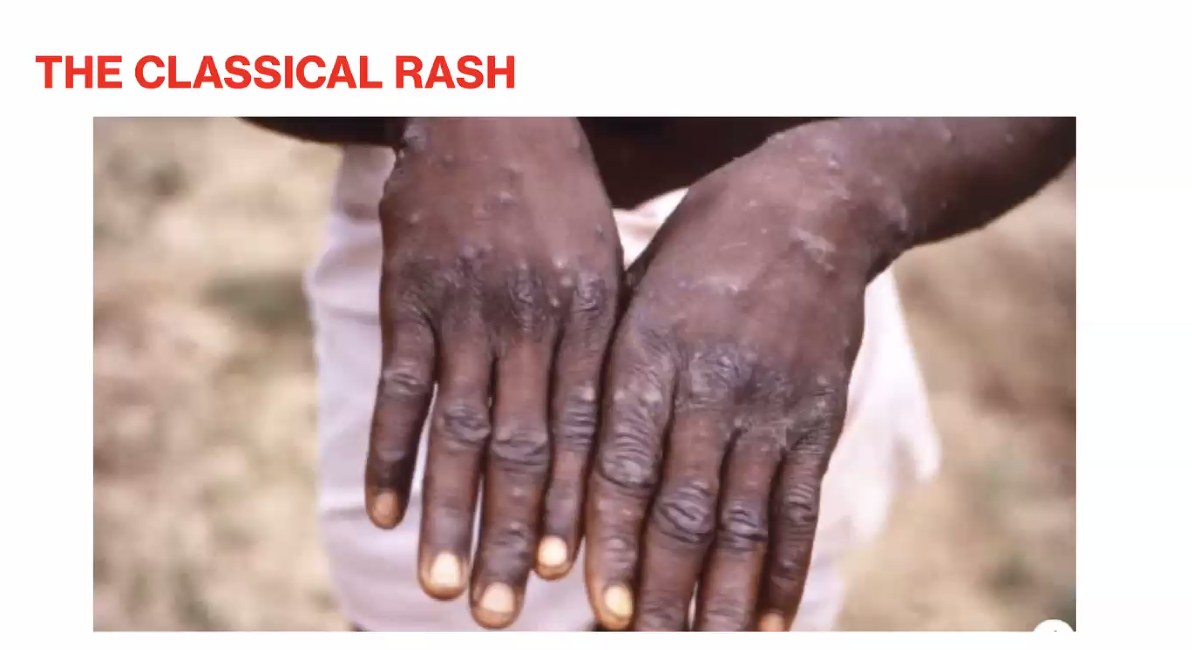 Adewole Urges Urgent National Effort To Tackle Mpox Disease