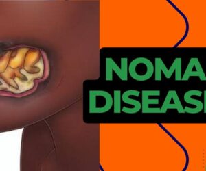 MSF Offers Free Life-changing Facial Surgeries For 1,074 Indigent Noma Survivors