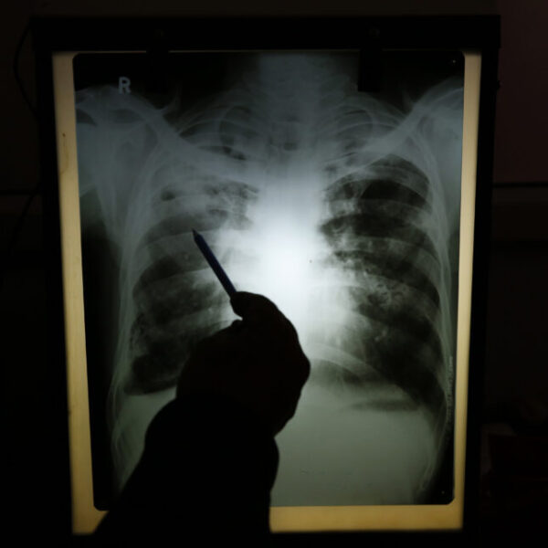Experts Say Stigma Worsening Nigeria’s TB Burden