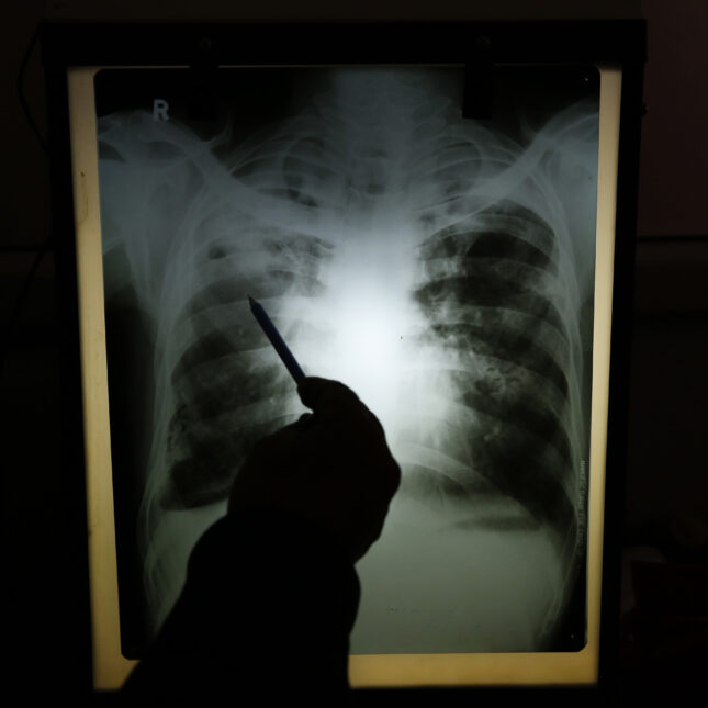 Experts Say Stigma Worsening Nigeria’s TB Burden
