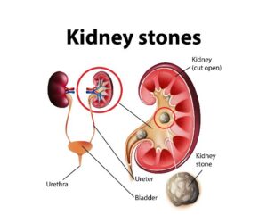 What you need to know about Kidney stones