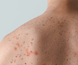 Orientation Agency Cautions Residents As Monkey Pox Hits 15 Akwa Ibom Councils