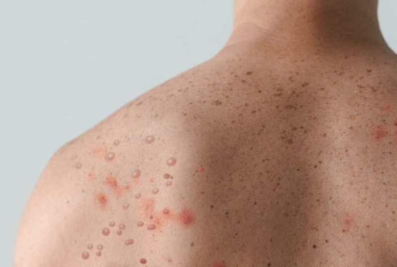 Orientation Agency Cautions Residents As Monkey Pox Hits 15 Akwa Ibom Councils