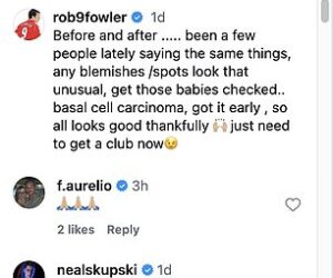 Liverpool legend, Robbie Fowler reveals he has undergone surgery to remove skin cancer from his face