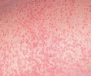 Kwara, 20 Other States To Repeat Polio Vaccination